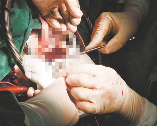 多学科协作完成手术。