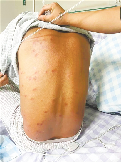 患者全身多处被马蜂蜇伤。 患者全身多处被马蜂蜇伤。