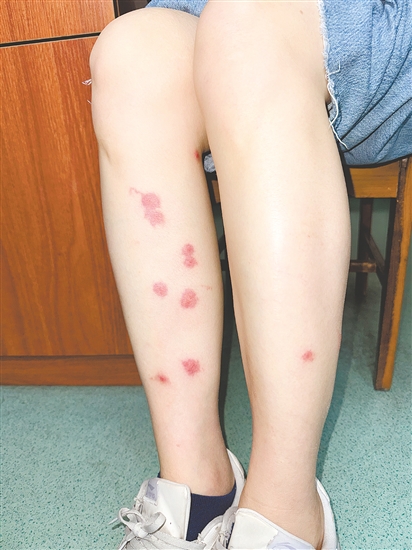 不同虫子叮咬后症状各不相同。